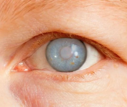 O que é Glaucoma?